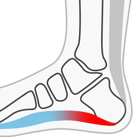 족저근막염